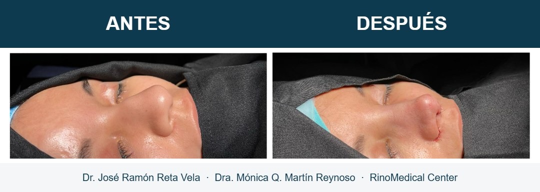 Rinoplastia, cambio inmediato en quirófano, caso 1 — Dr. José Ramón Reta Vela y Dra. Mónica Q. Martín Reynoso, RinoMedical Center Mexicali
