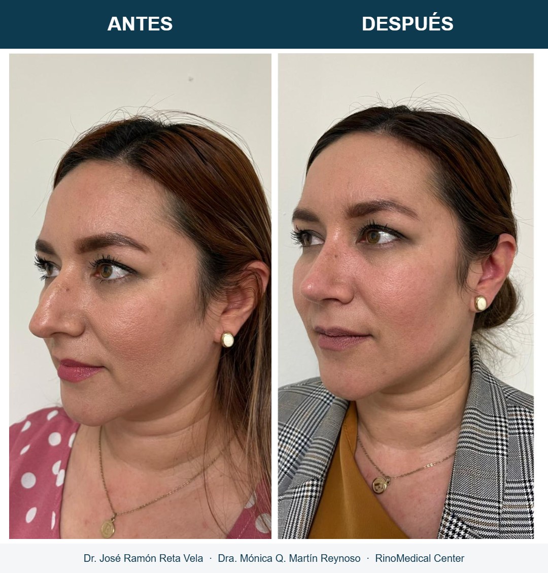 Rinoplastia, cambio inmediato en quirófano, caso 2 — Dr. José Ramón Reta Vela y Dra. Mónica Q. Martín Reynoso, RinoMedical Center Mexicali