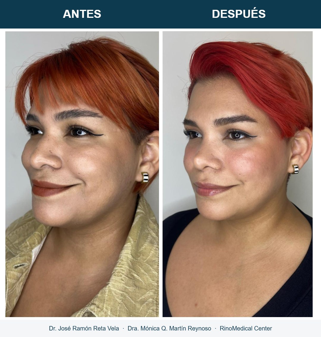 Rinoplastia, cambio inmediato en quirófano, caso 3 — Dr. José Ramón Reta Vela y Dra. Mónica Q. Martín Reynoso, RinoMedical Center Mexicali