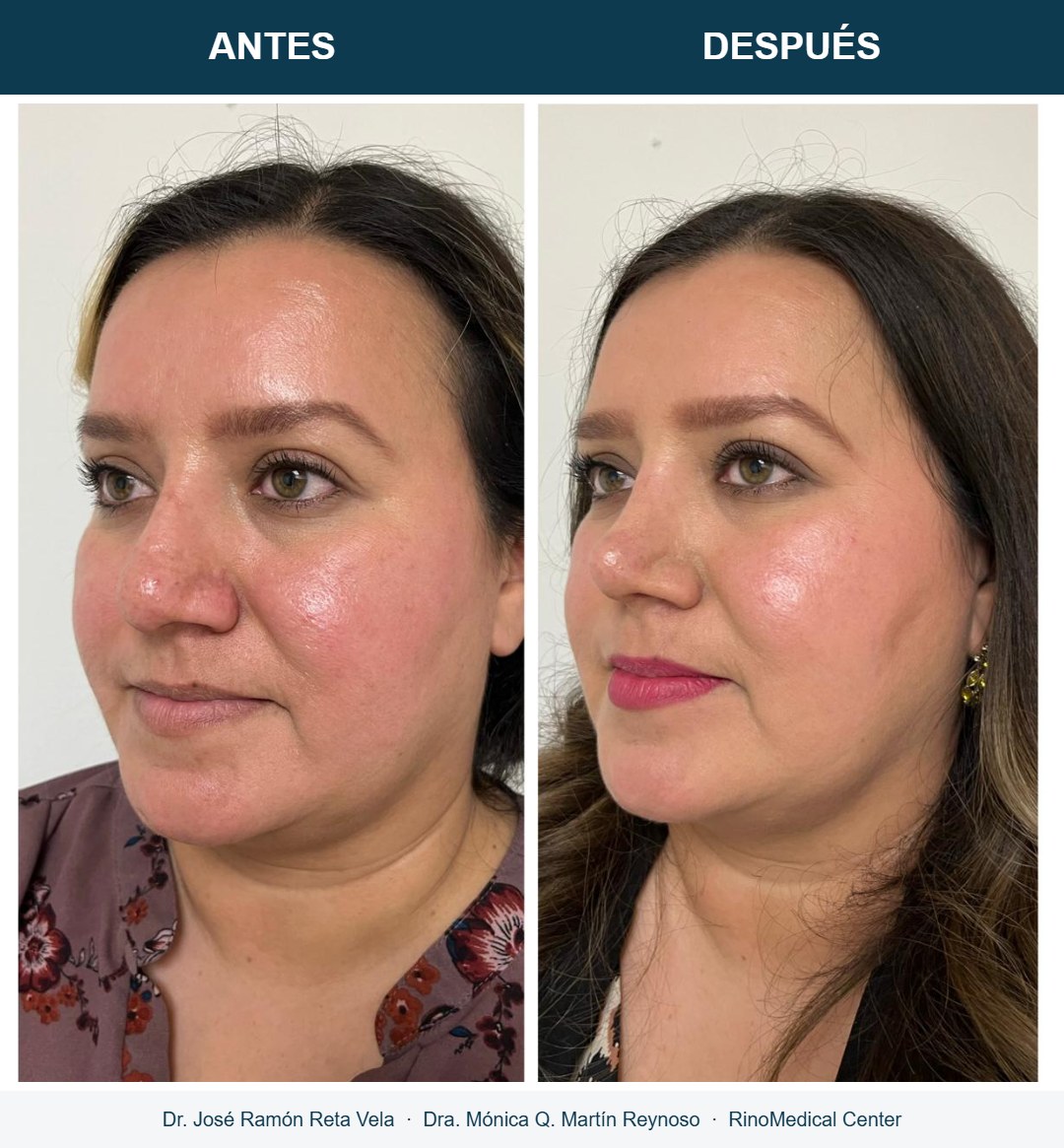 Rinoplastia, cambio inmediato en quirófano, caso 4 — Dr. José Ramón Reta Vela y Dra. Mónica Q. Martín Reynoso, RinoMedical Center Mexicali