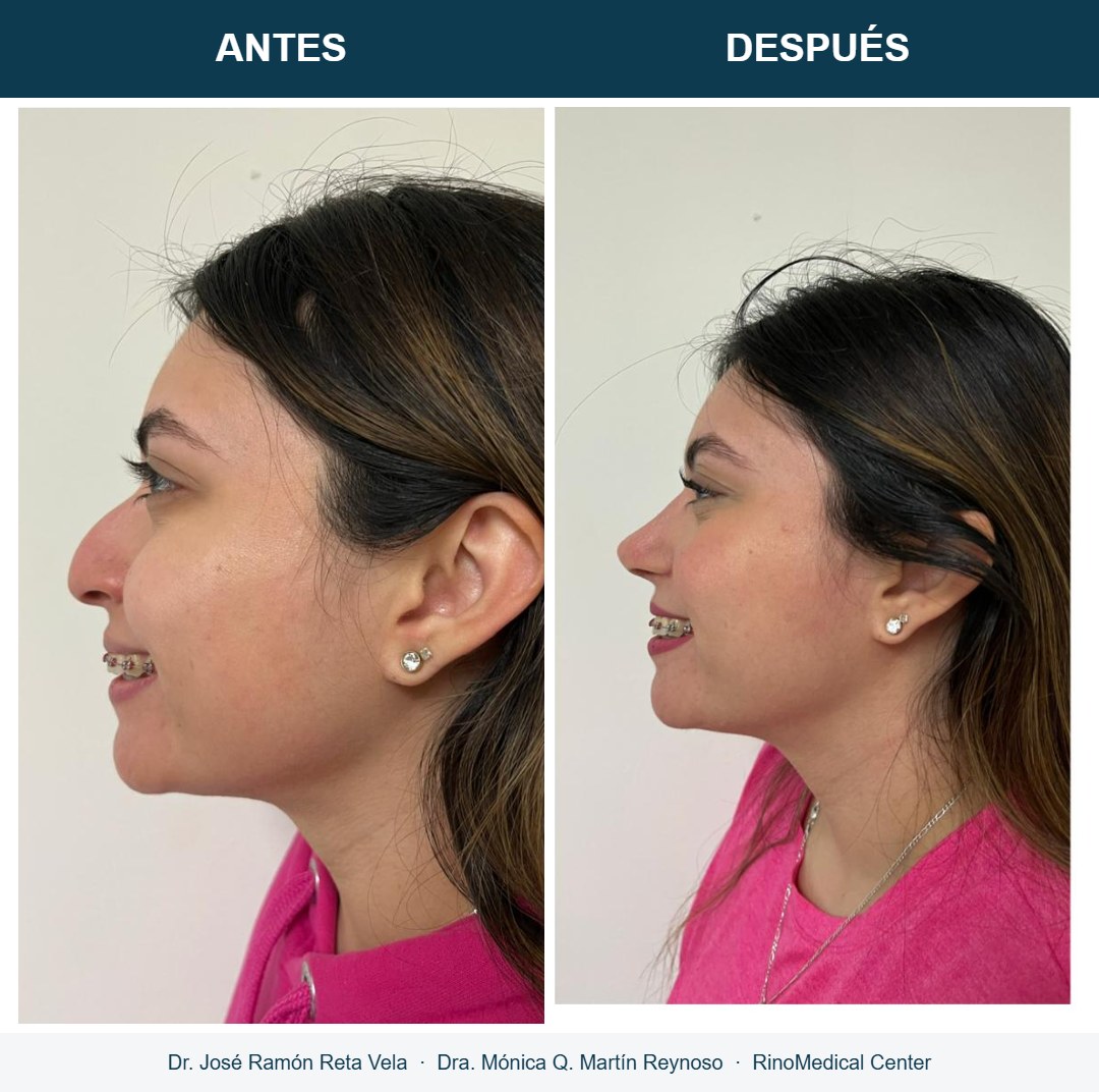 Rinoplastia, cambio inmediato en quirófano, caso 5 — Dr. José Ramón Reta Vela y Dra. Mónica Q. Martín Reynoso, RinoMedical Center Mexicali