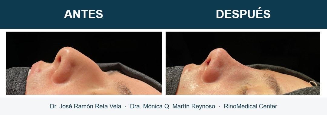 Rinoplastia, cambio inmediato en quirófano, caso 7 — Dr. José Ramón Reta Vela y Dra. Mónica Q. Martín Reynoso, RinoMedical Center Mexicali