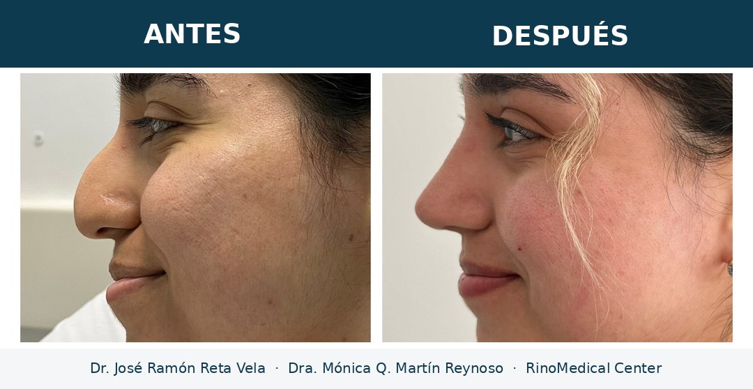 Rinoplastia antes y después, paciente 1 — Dr. José Ramón Reta Vela y Dra. Mónica Q. Martín Reynoso, RinoMedical Center Mexicali