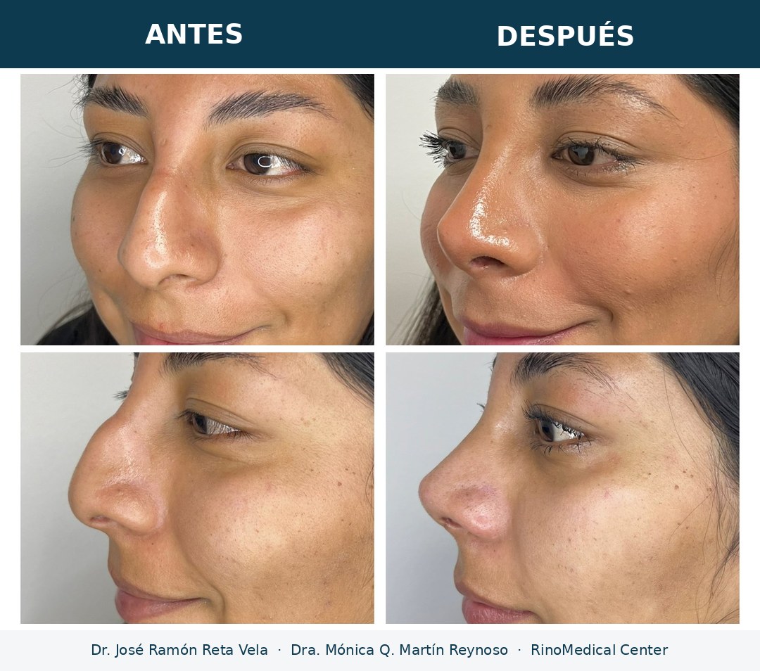 Rinoplastia antes y después, paciente 2 — Dr. José Ramón Reta Vela y Dra. Mónica Q. Martín Reynoso, RinoMedical Center Mexicali