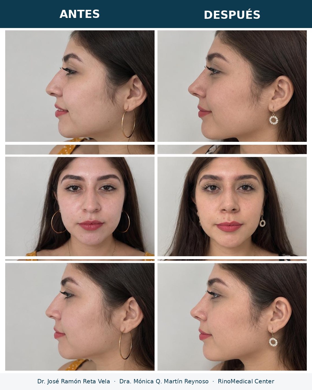 Rinoplastia antes y después en tres vistas, frente y perfiles — Dr. José Ramón Reta Vela y Dra. Mónica Q. Martín Reynoso, RinoMedical Center Mexicali