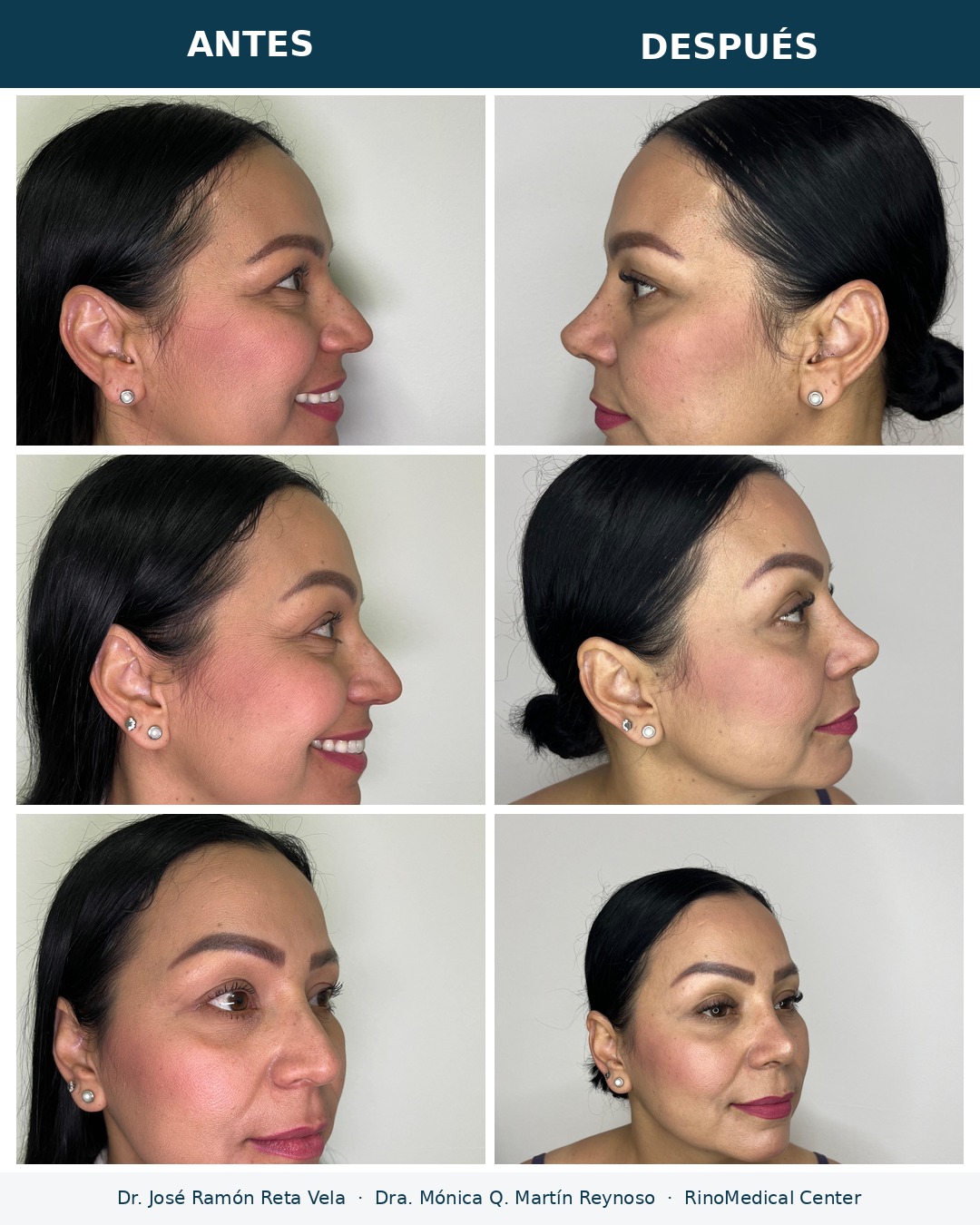 Rinoplastia antes y después, paciente 4, dos vistas — Dr. José Ramón Reta Vela y Dra. Mónica Q. Martín Reynoso, RinoMedical Center Mexicali