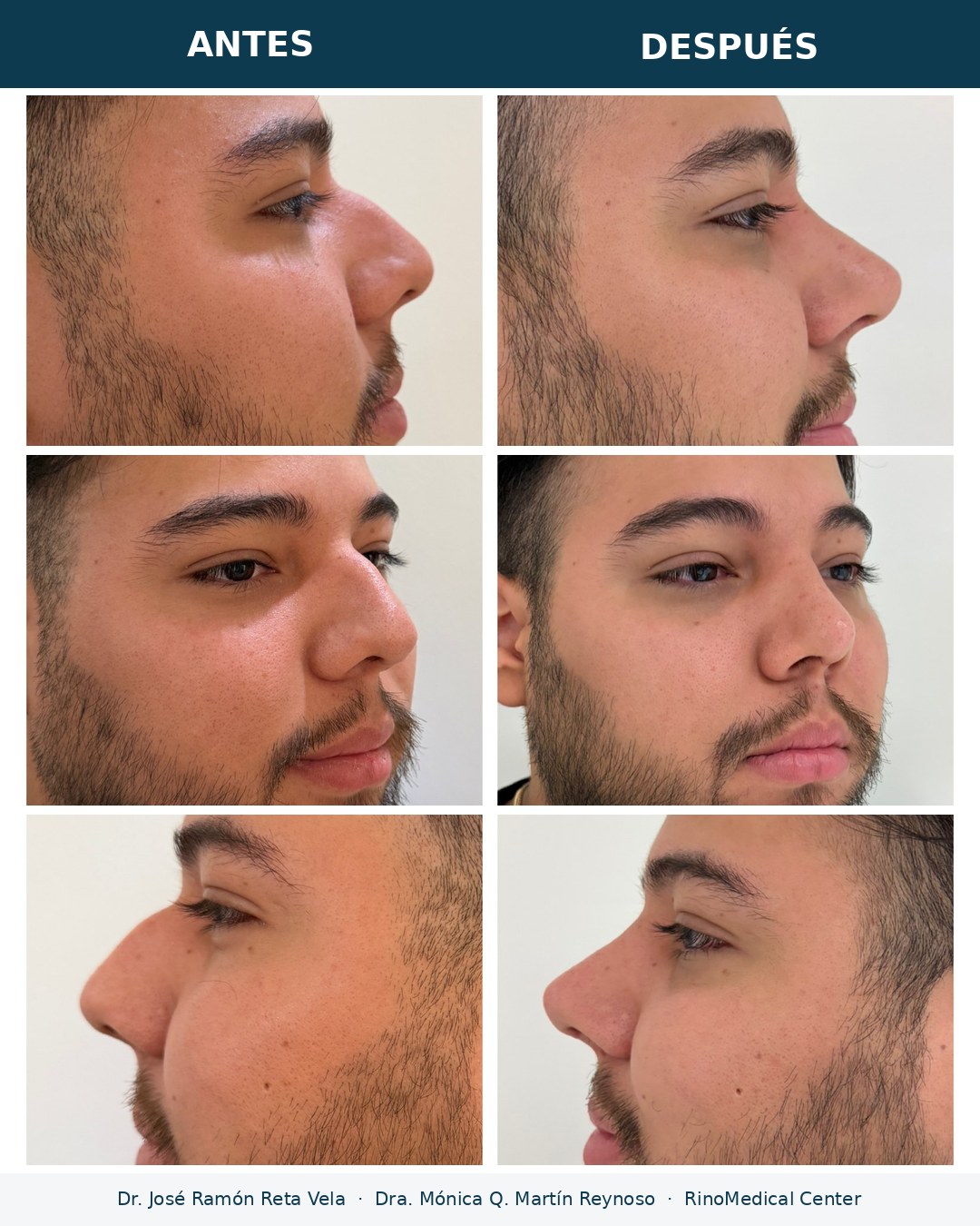 Rinoplastia en hombre, reducción de giba nasal, antes y después — Dr. José Ramón Reta Vela y Dra. Mónica Q. Martín Reynoso, RinoMedical Center Mexicali