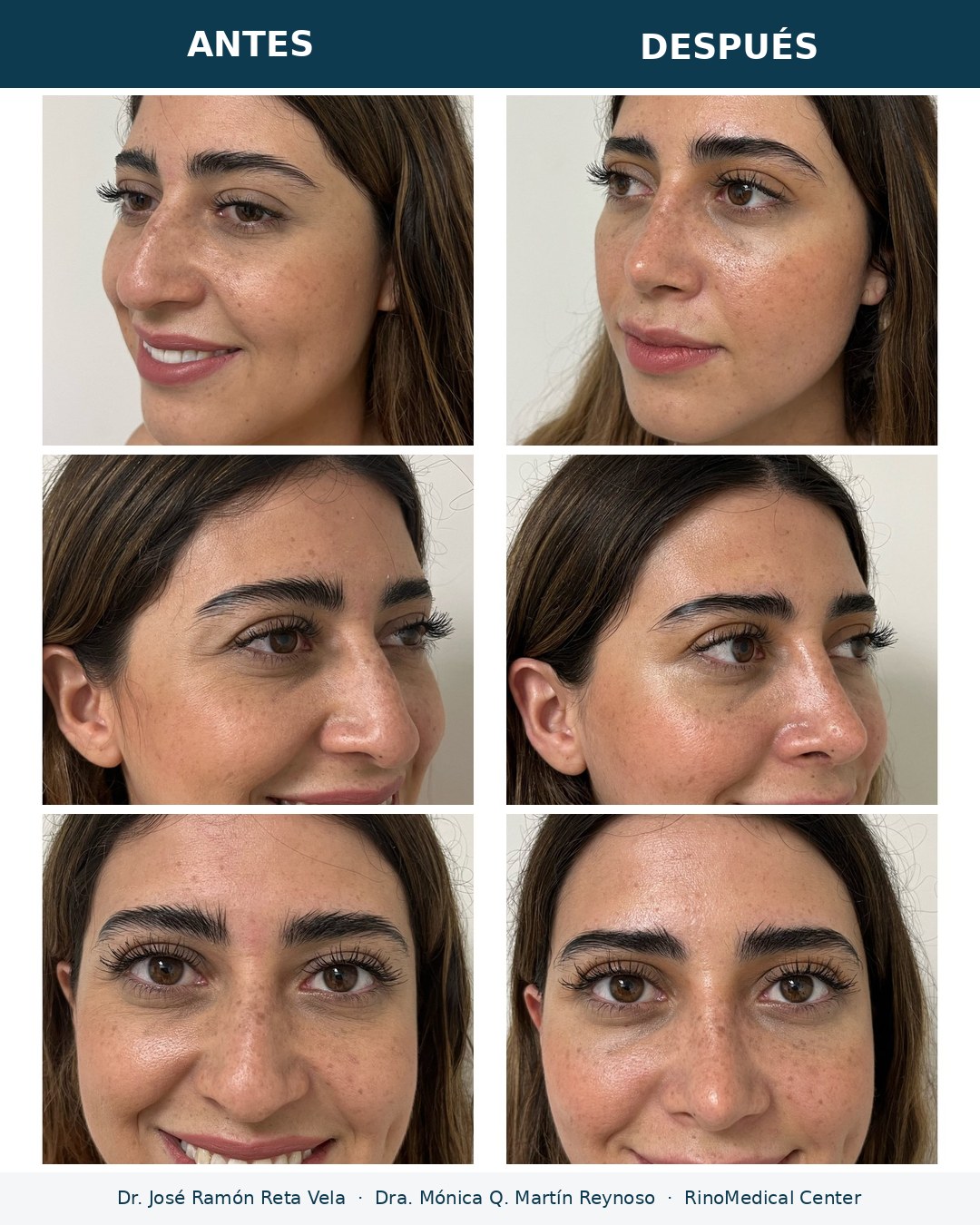 Rinoplastia antes y después, paciente 6 — Dr. José Ramón Reta Vela y Dra. Mónica Q. Martín Reynoso, RinoMedical Center Mexicali