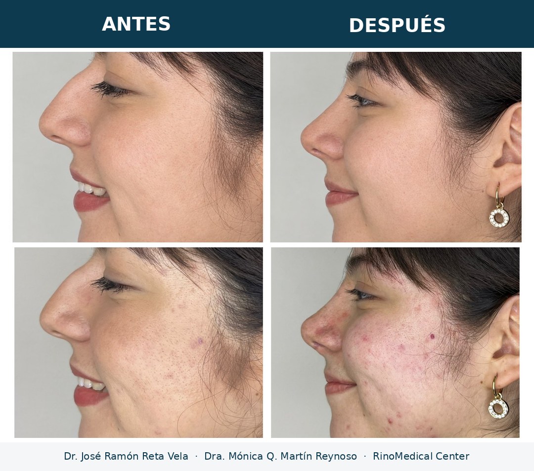 Rinoplastia antes y después, giba nasal y punta caída corregidas — Dr. José Ramón Reta Vela y Dra. Mónica Q. Martín Reynoso, RinoMedical Center Mexicali