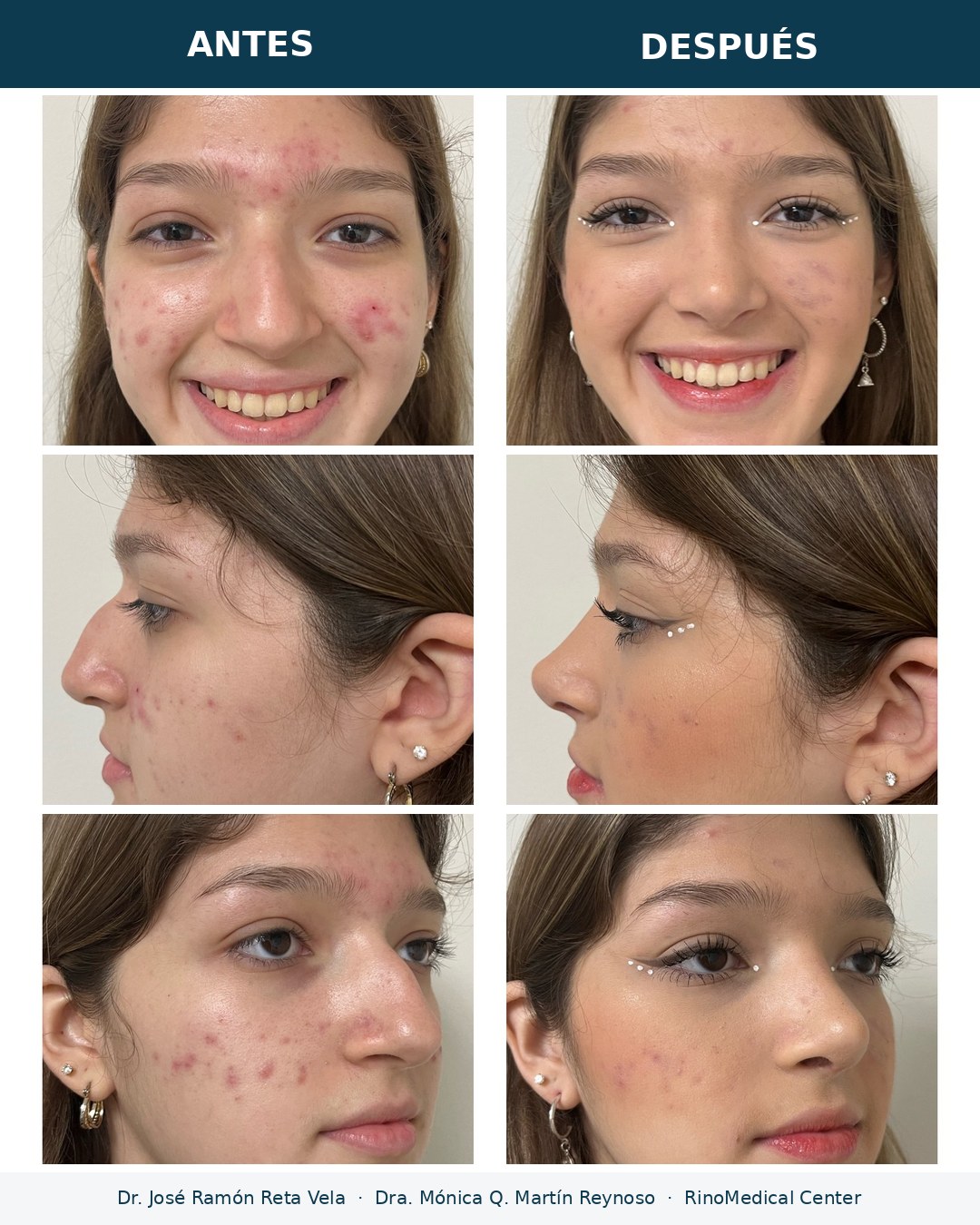 Rinoplastia antes y después, resultado natural — Dr. José Ramón Reta Vela y Dra. Mónica Q. Martín Reynoso, RinoMedical Center Mexicali