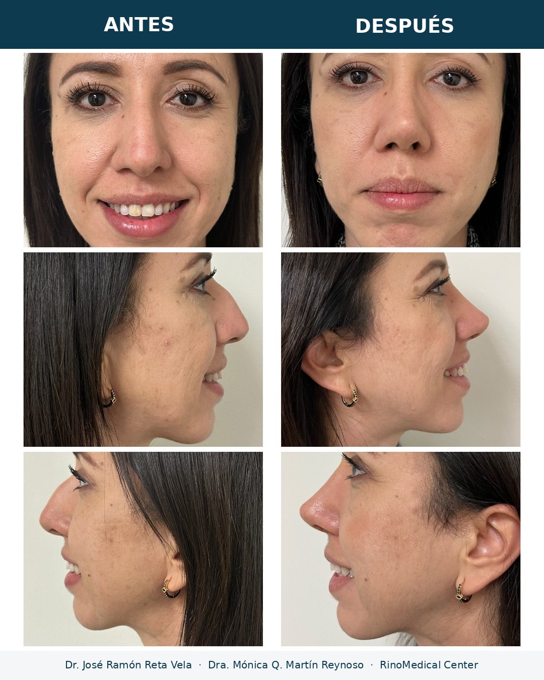 Rinoplastia antes y después en tres vistas — Dr. José Ramón Reta Vela y Dra. Mónica Q. Martín Reynoso, RinoMedical Center Mexicali
