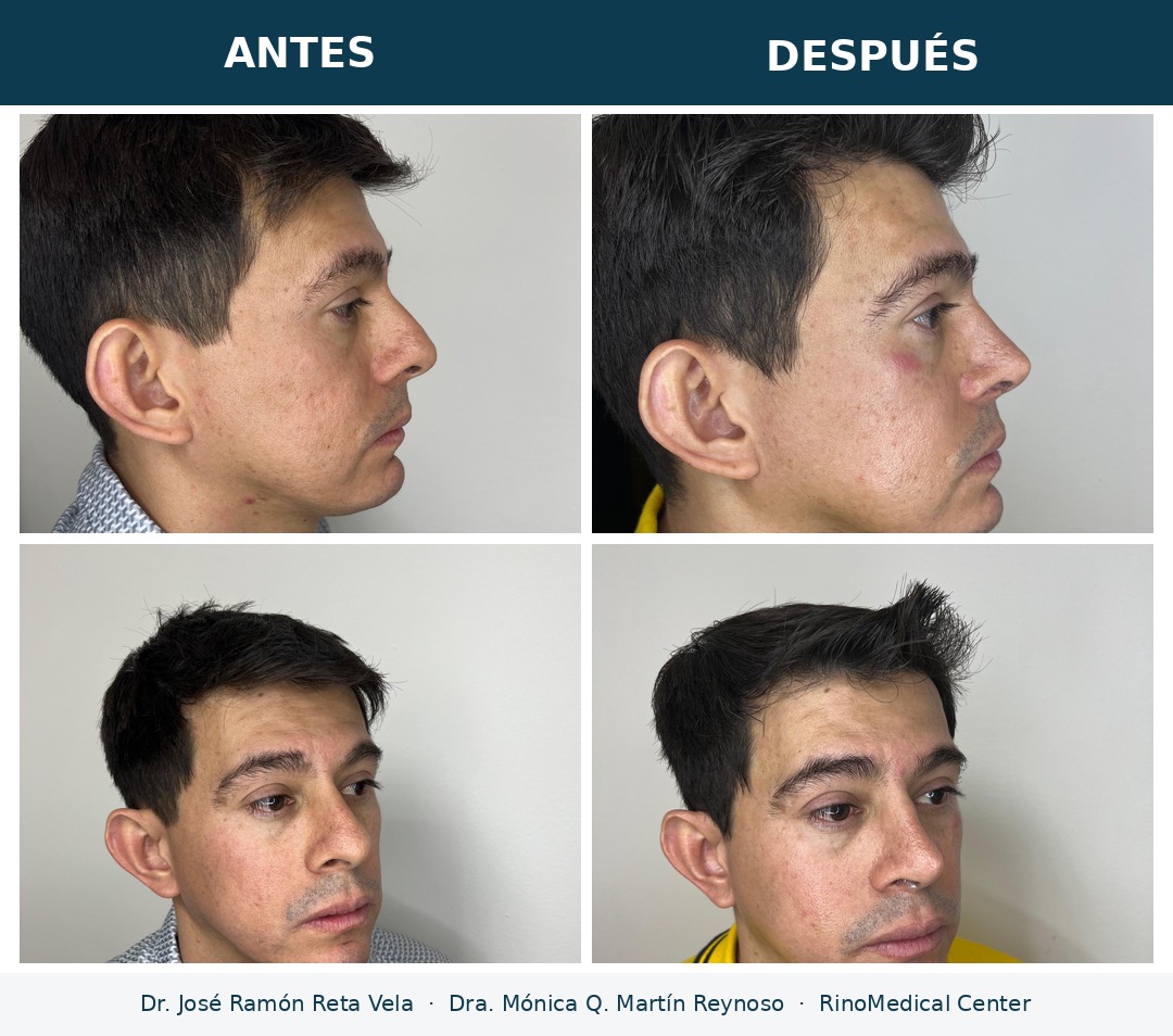 Rinoplastia en hombre, antes y después — Dr. José Ramón Reta Vela y Dra. Mónica Q. Martín Reynoso, RinoMedical Center Mexicali