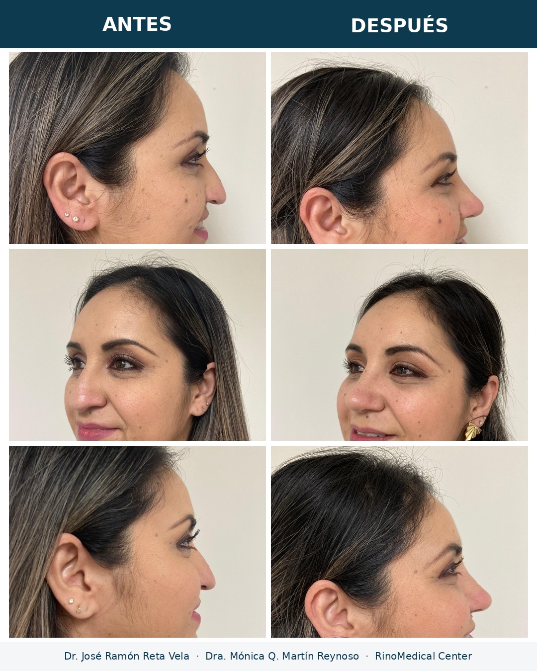 Rinoplastia antes y después en tres vistas — Dr. José Ramón Reta Vela y Dra. Mónica Q. Martín Reynoso, RinoMedical Center Mexicali
