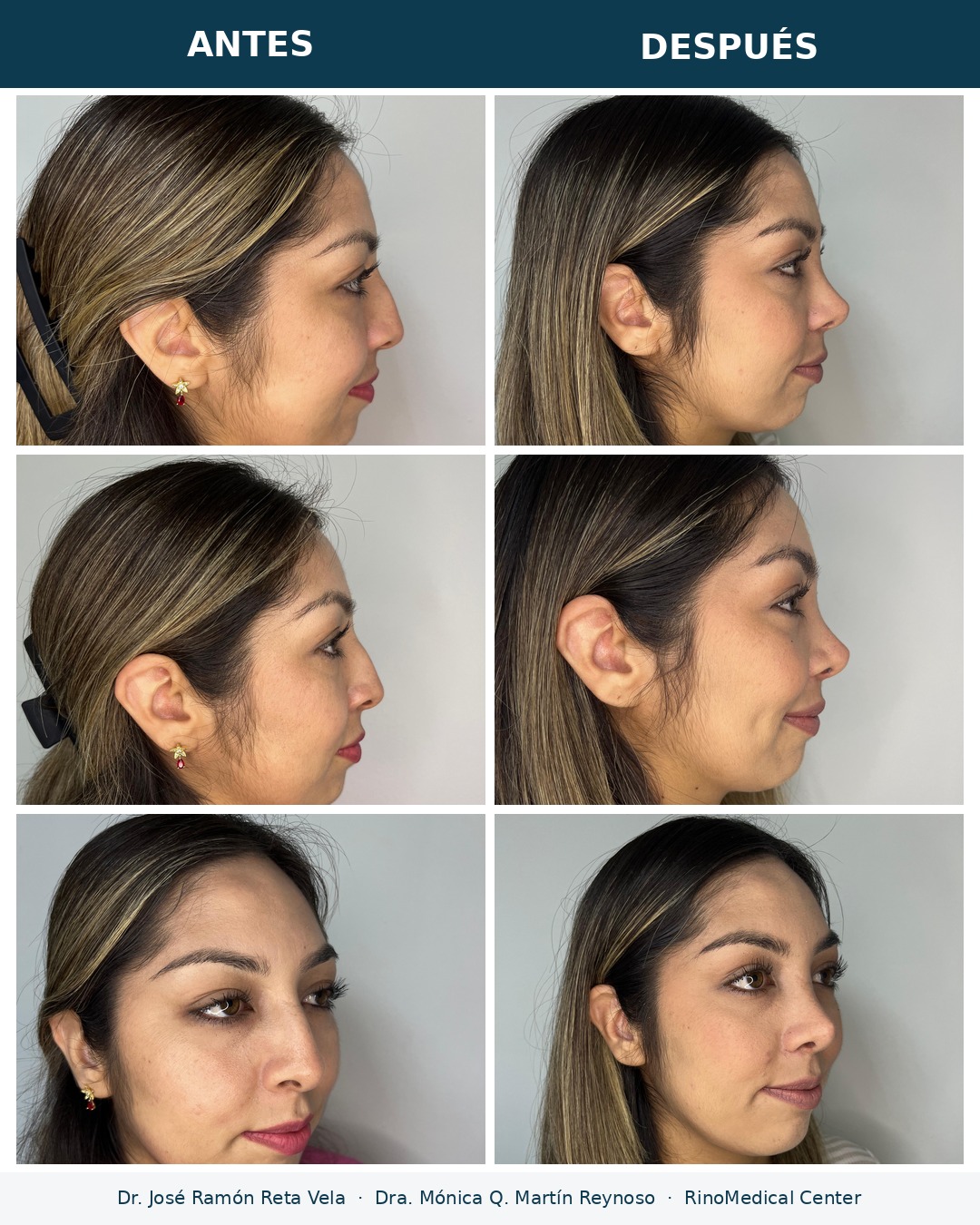 Rinoplastia antes y después en tres vistas — Dr. José Ramón Reta Vela y Dra. Mónica Q. Martín Reynoso, RinoMedical Center Mexicali