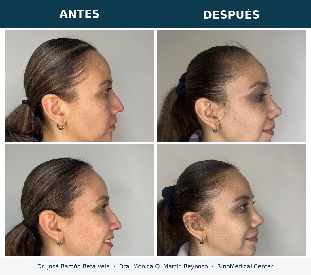 Rinoplastia antes y después, perfil — Dr. José Ramón Reta Vela y Dra. Mónica Q. Martín Reynoso, RinoMedical Center Mexicali